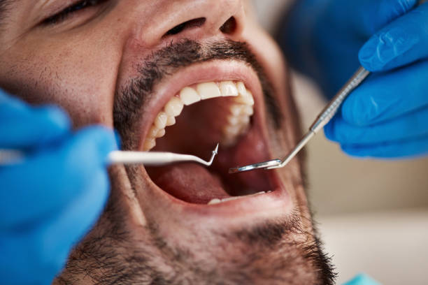 Best Emergency Dentist for Knocked-Out Tooth in Anderson Creek, NC